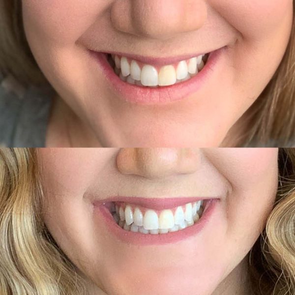 crest 3d white glamorous whitestrips results