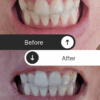 crest whitening strips before and after